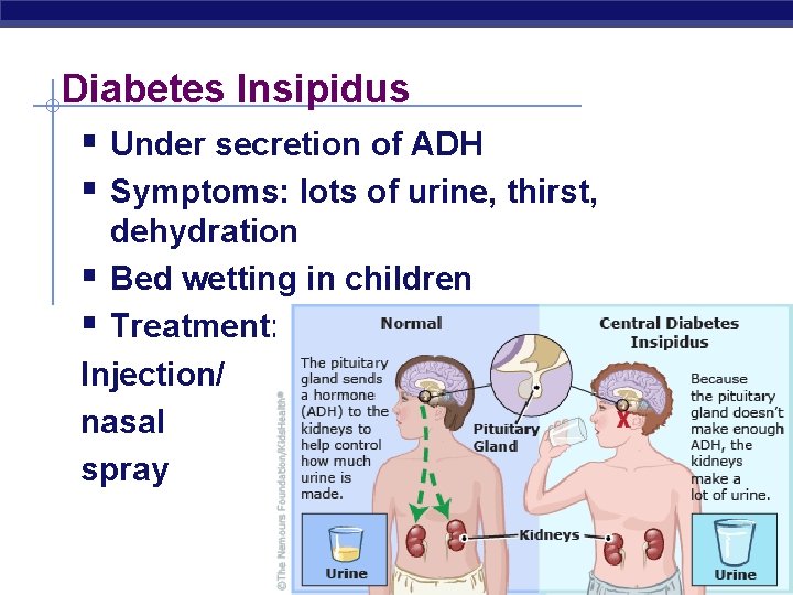 Diabetes Insipidus § Under secretion of ADH § Symptoms: lots of urine, thirst, dehydration