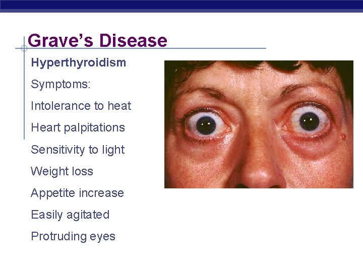 Grave’s Disease Hyperthyroidism Symptoms: Intolerance to heat Heart palpitations Sensitivity to light Weight loss