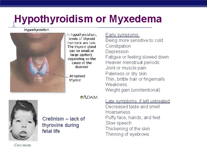 Hypothyroidism or Myxedema Early symptoms: Being more sensitive to cold Constipation Depression Fatigue or