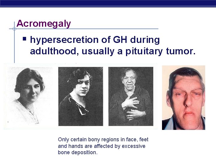 Acromegaly § hypersecretion of GH during adulthood, usually a pituitary tumor. Only certain bony