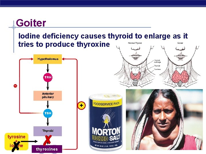 Goiter Iodine deficiency causes thyroid to enlarge as it tries to produce thyroxine +