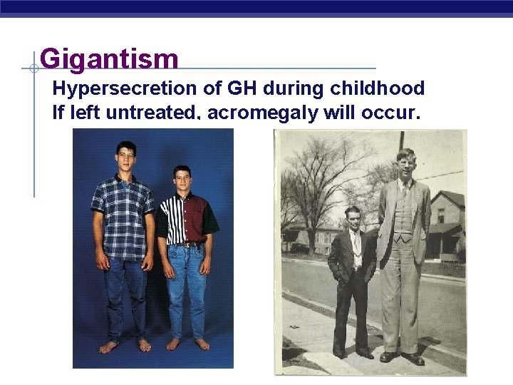 Gigantism Hypersecretion of GH during childhood If left untreated, acromegaly will occur. 