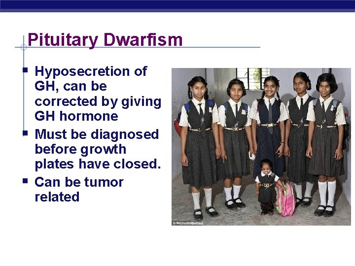 Pituitary Dwarfism § Hyposecretion of § § GH, can be corrected by giving GH