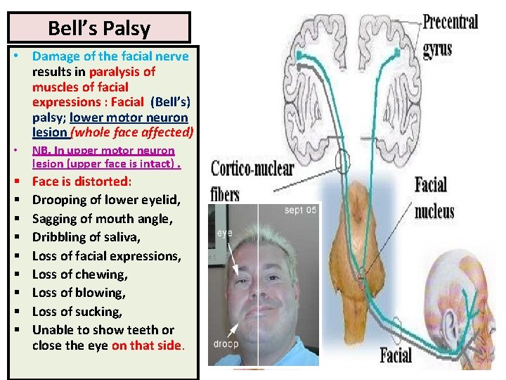 Bell’s Palsy • Damage of the facial nerve results in paralysis of muscles of