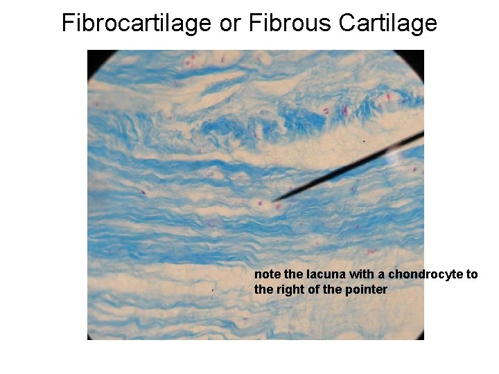 Fibrocartilage or Fibrous Cartilage note the lacuna with a chondrocyte to the right of