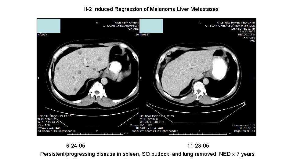 Il-2 Induced Regression of Melanoma Liver Metastases 6 -24 -05 11 -23 -05 Persistent/progressing