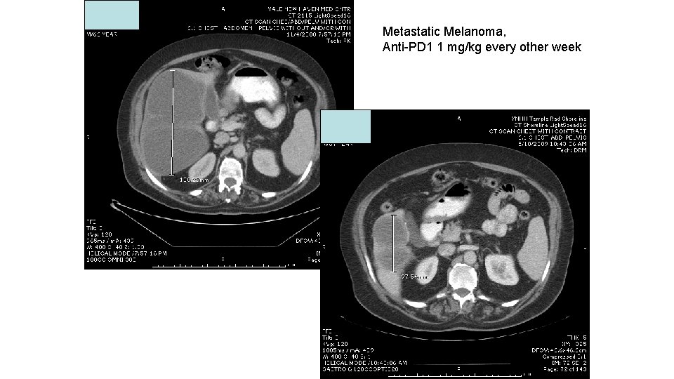 Metastatic Melanoma, Anti-PD 1 1 mg/kg every other week 