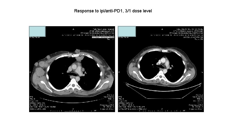 Response to ipi/anti-PD 1, 3/1 dose level 