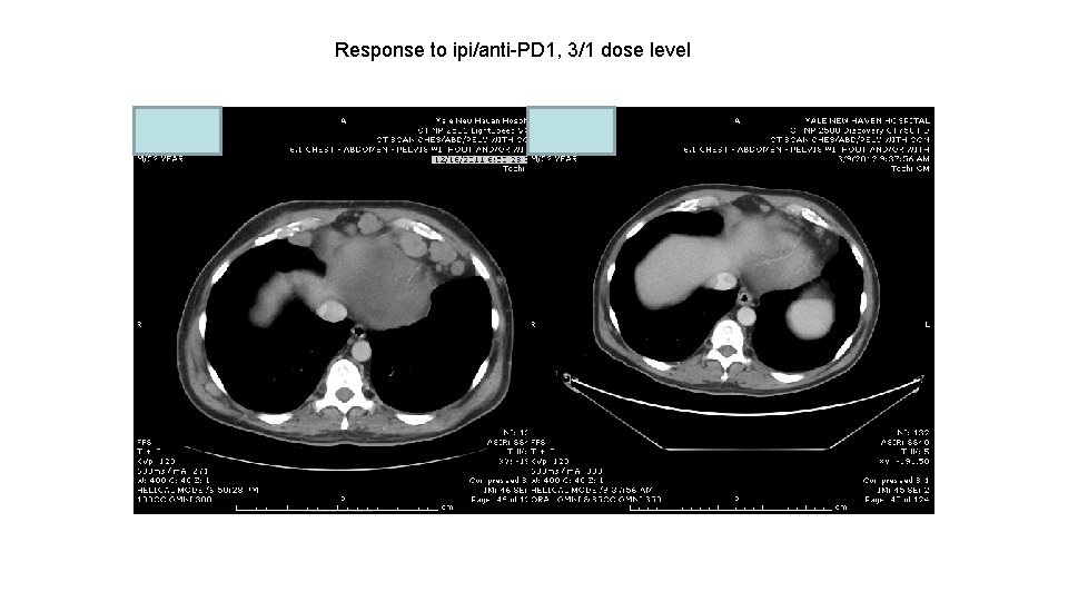 Response to ipi/anti-PD 1, 3/1 dose level 