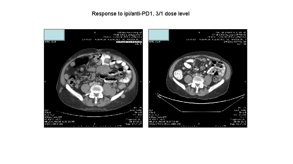 Response to ipi/anti-PD 1, 3/1 dose level 