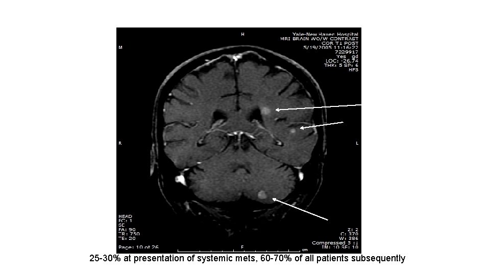 25 -30% at presentation of systemic mets, 60 -70% of all patients subsequently 