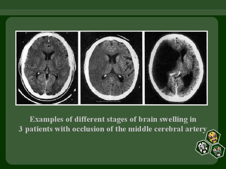 Examples of different stages of brain swelling in 3 patients with occlusion of the