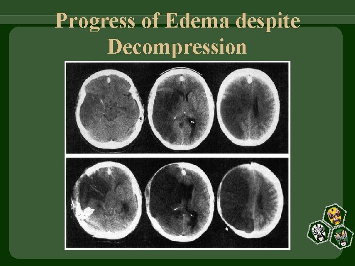 Progress of Edema despite Decompression 