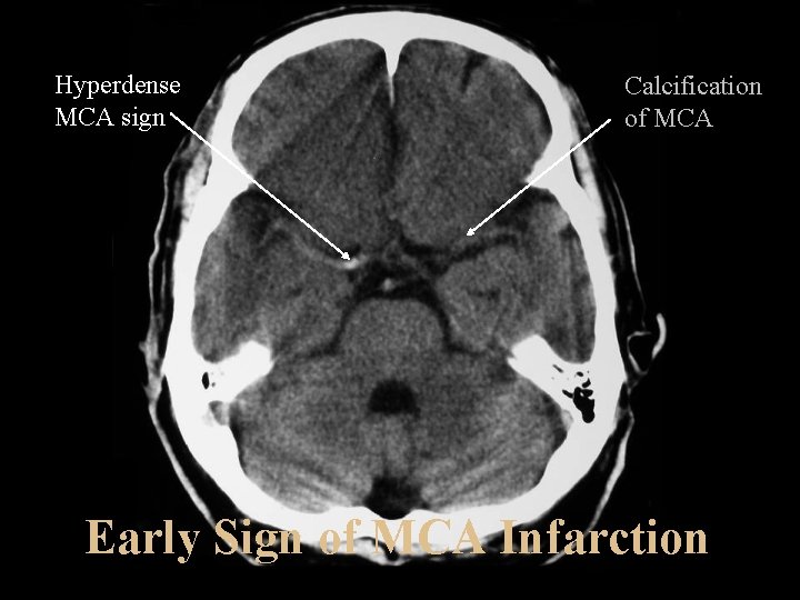 Hyperdense MCA sign Calcification of MCA Early Sign of MCA Infarction 