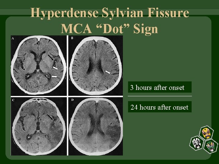 Hyperdense Sylvian Fissure MCA “Dot” Sign 3 hours after onset 24 hours after onset