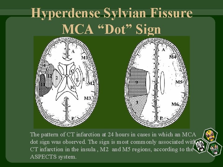 Hyperdense Sylvian Fissure MCA “Dot” Sign The pattern of CT infarction at 24 hours