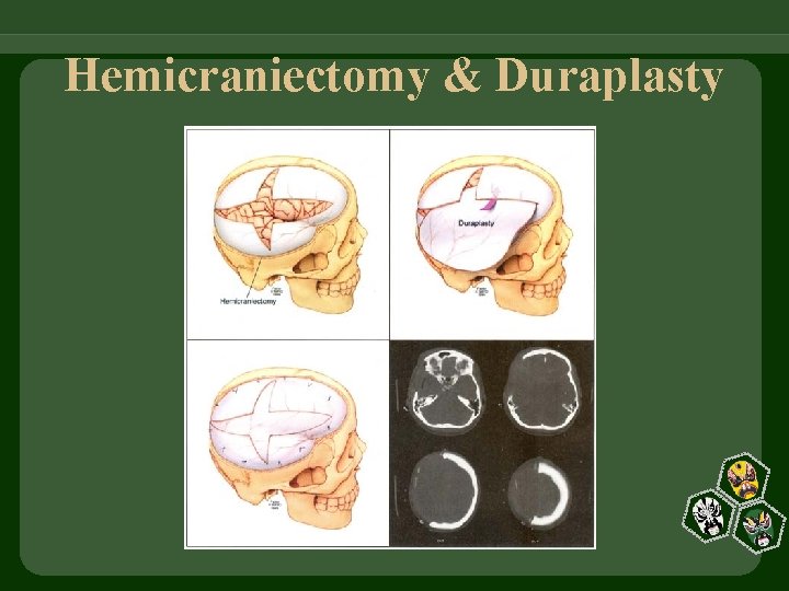 Hemicraniectomy & Duraplasty 