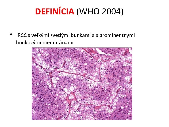 DEFINÍCIA (WHO 2004) • RCC s veľkými svetlými bunkami a s prominentnými bunkovými membránami