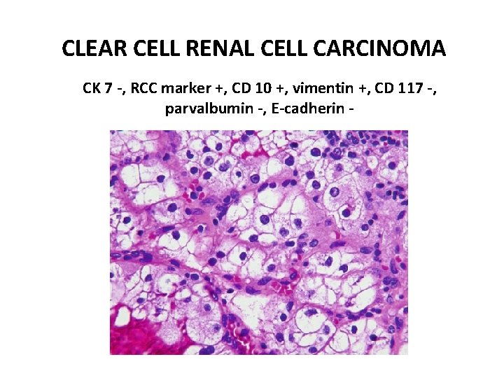 CLEAR CELL RENAL CELL CARCINOMA CK 7 -, RCC marker +, CD 10 +,