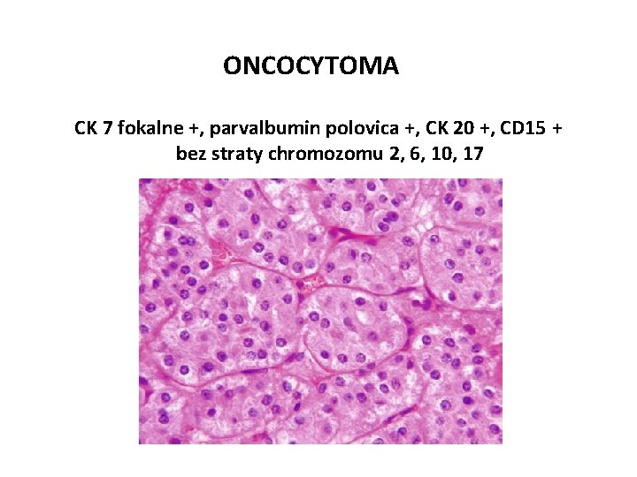 ONCOCYTOMA CK 7 fokalne +, parvalbumin polovica +, CK 20 +, CD 15 +