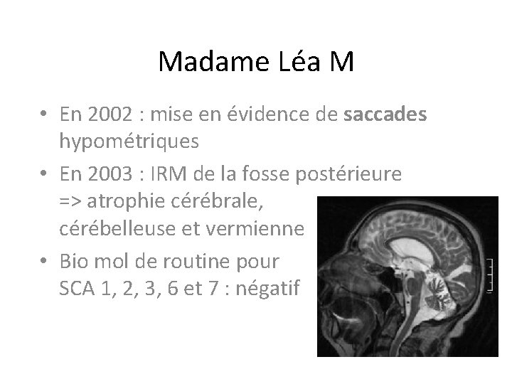 Madame Léa M • En 2002 : mise en évidence de saccades hypométriques • Madame Léa M • En 2002 : mise en évidence de saccades hypométriques •