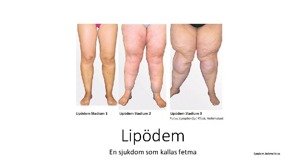 Lipödem En sjukdom som kallas fetma lipodem. bohmelin. se 