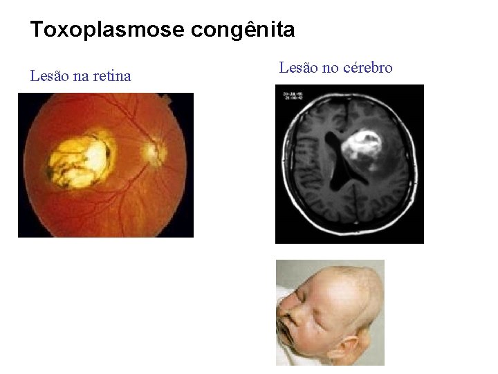 Toxoplasmose congênita Lesão na retina Lesão no cérebro 