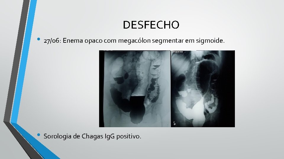 DESFECHO • 27/06: Enema opaco com megacólon segmentar em sigmoide. • Sorologia de Chagas