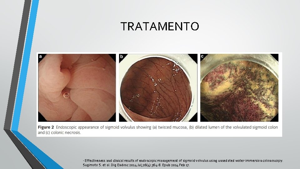 TRATAMENTO - Effectiveness and clinical results of endoscopic management of sigmoid volvulus using unsedated