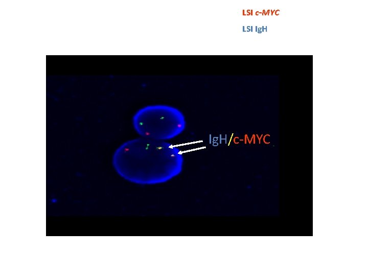 LSI c-MYC LSI Ig. H/c-MYC LSI c-MYC LSI Ig. H/c-MYC