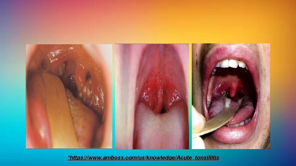 *https: //www. amboss. com/us/knowledge/Acute_tonsillitis 