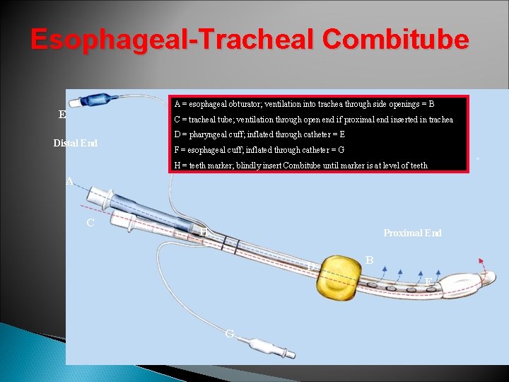 Esophageal-Tracheal Combitube A = esophageal obturator; ventilation into trachea through side openings = B