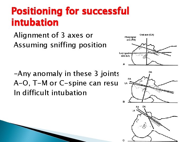 Positioning for successful intubation Alignment of 3 axes or Assuming sniffing position -Any anomaly