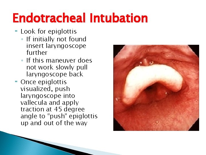 Endotracheal Intubation Look for epiglottis ◦ If initially not found insert laryngoscope further ◦