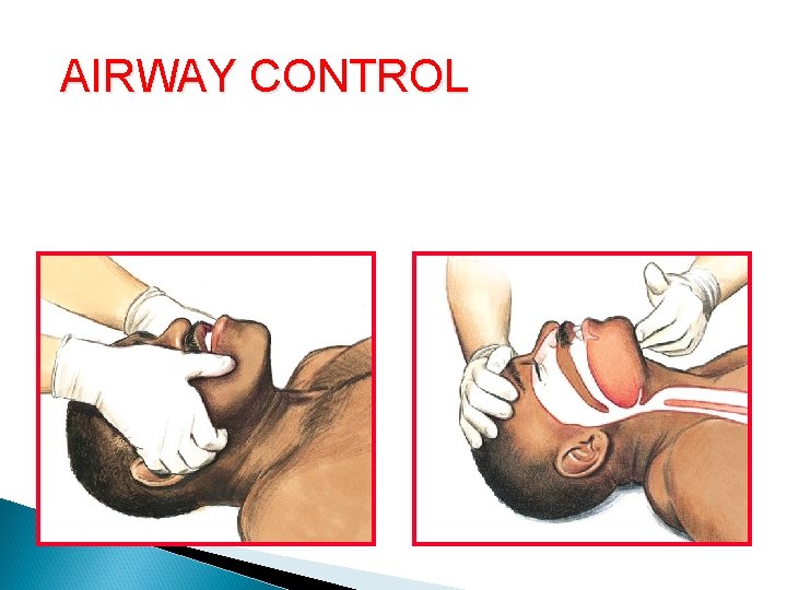AIRWAY CONTROL Opening the Airway Jaw thrust Head tilt–chin lift 