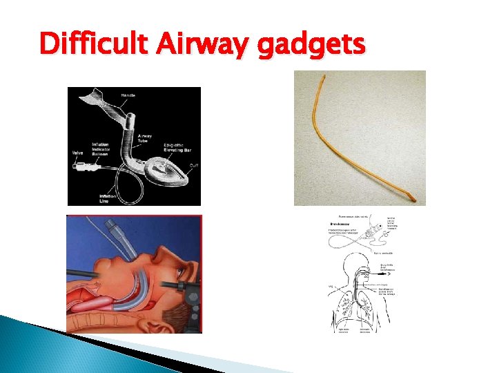 Difficult Airway gadgets 
