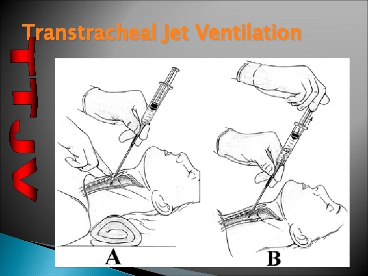 Transtracheal Jet Ventilation 