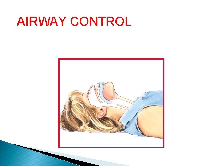 AIRWAY CONTROL Oropharyngeal Airway (cont. ) 