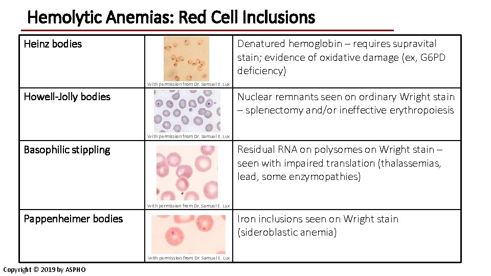 Hemolytic Anemias: Red Cell Inclusions Heinz bodies Denatured hemoglobin – requires supravital stain; evidence