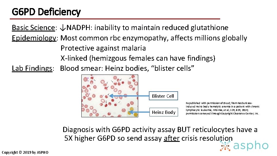 G 6 PD Deficiency Basic Science: ↓NADPH: inability to maintain reduced glutathione Epidemiology: Most