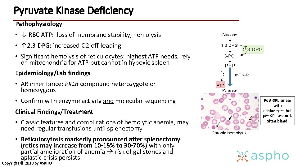 Pyruvate Kinase Deficiency Pathophysiology • ↓ RBC ATP: loss of membrane stability, hemolysis •