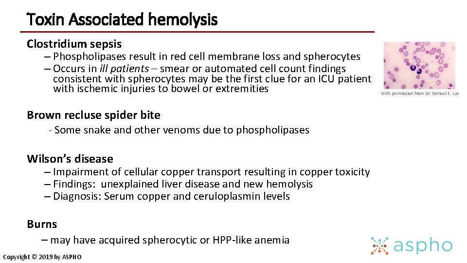 Toxin Associated hemolysis Clostridium sepsis – Phospholipases result in red cell membrane loss and