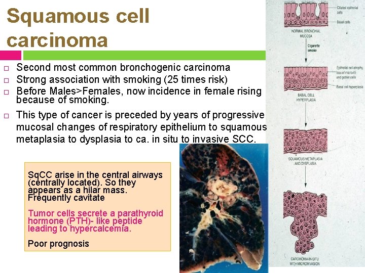 Squamous cell carcinoma Second most common bronchogenic carcinoma Strong association with smoking (25 times