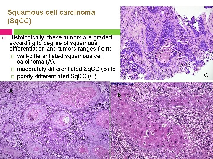 Squamous cell carcinoma (Sq. CC) Histologically, these tumors are graded according to degree of