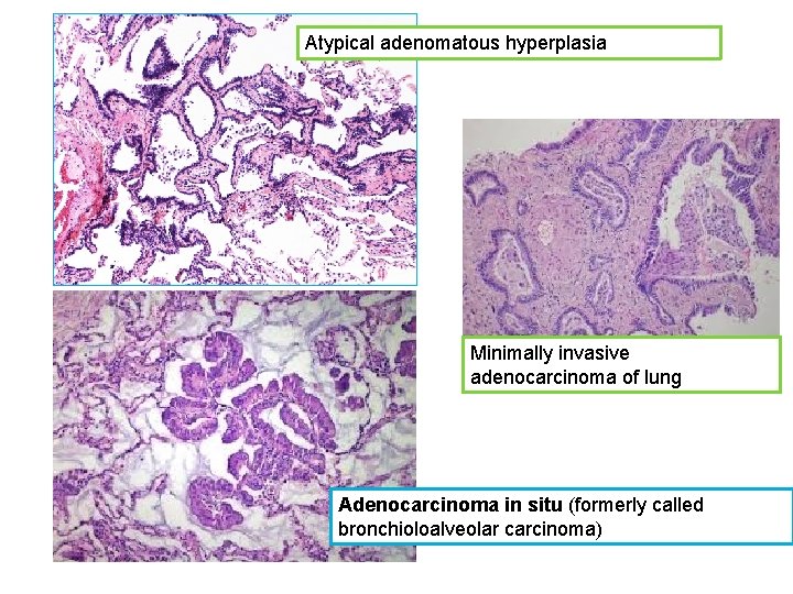 Atypical adenomatous hyperplasia Minimally invasive adenocarcinoma of lung Adenocarcinoma in situ (formerly called bronchioloalveolar