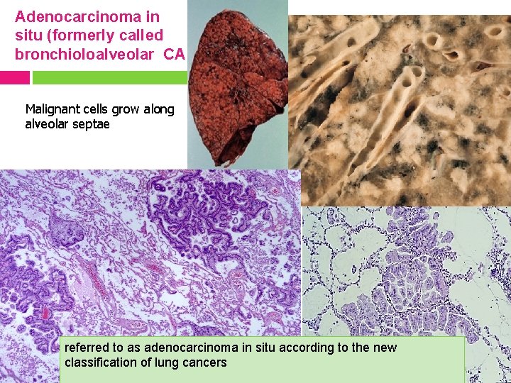 Adenocarcinoma in situ (formerly called bronchioloalveolar CA Malignant cells grow along alveolar septae referred