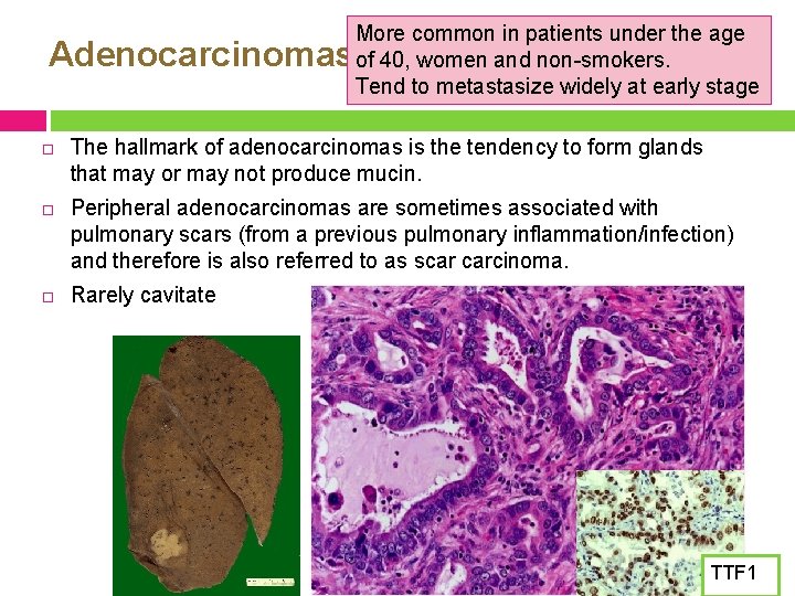 Adenocarcinomas More common in patients under the age of 40, women and non-smokers. Tend