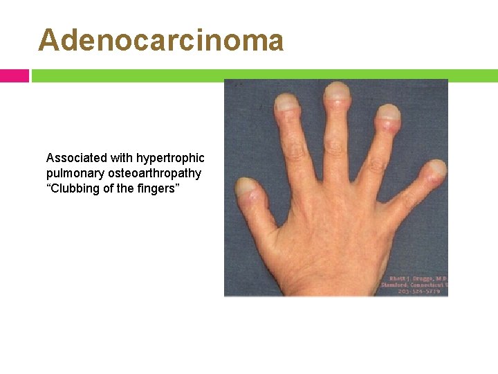 Adenocarcinoma Associated with hypertrophic pulmonary osteoarthropathy “Clubbing of the fingers” 