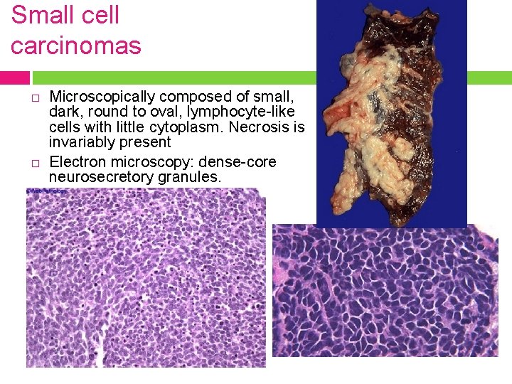 Small cell carcinomas Microscopically composed of small, dark, round to oval, lymphocyte-like cells with