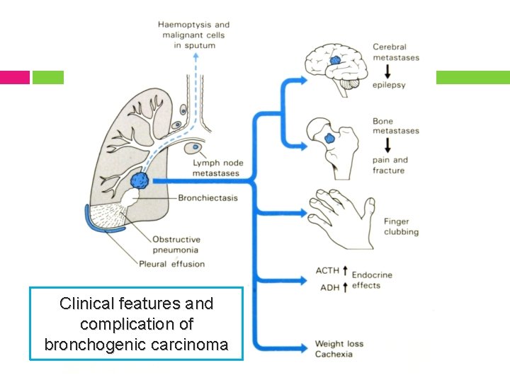 Clinical features and complication of bronchogenic carcinoma 